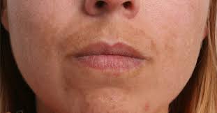 Causes And Treatments Of Upper Lip Discoloration New Health Advisor Causes And Treatments Of Upper Lip Discoloration New Health Advisor